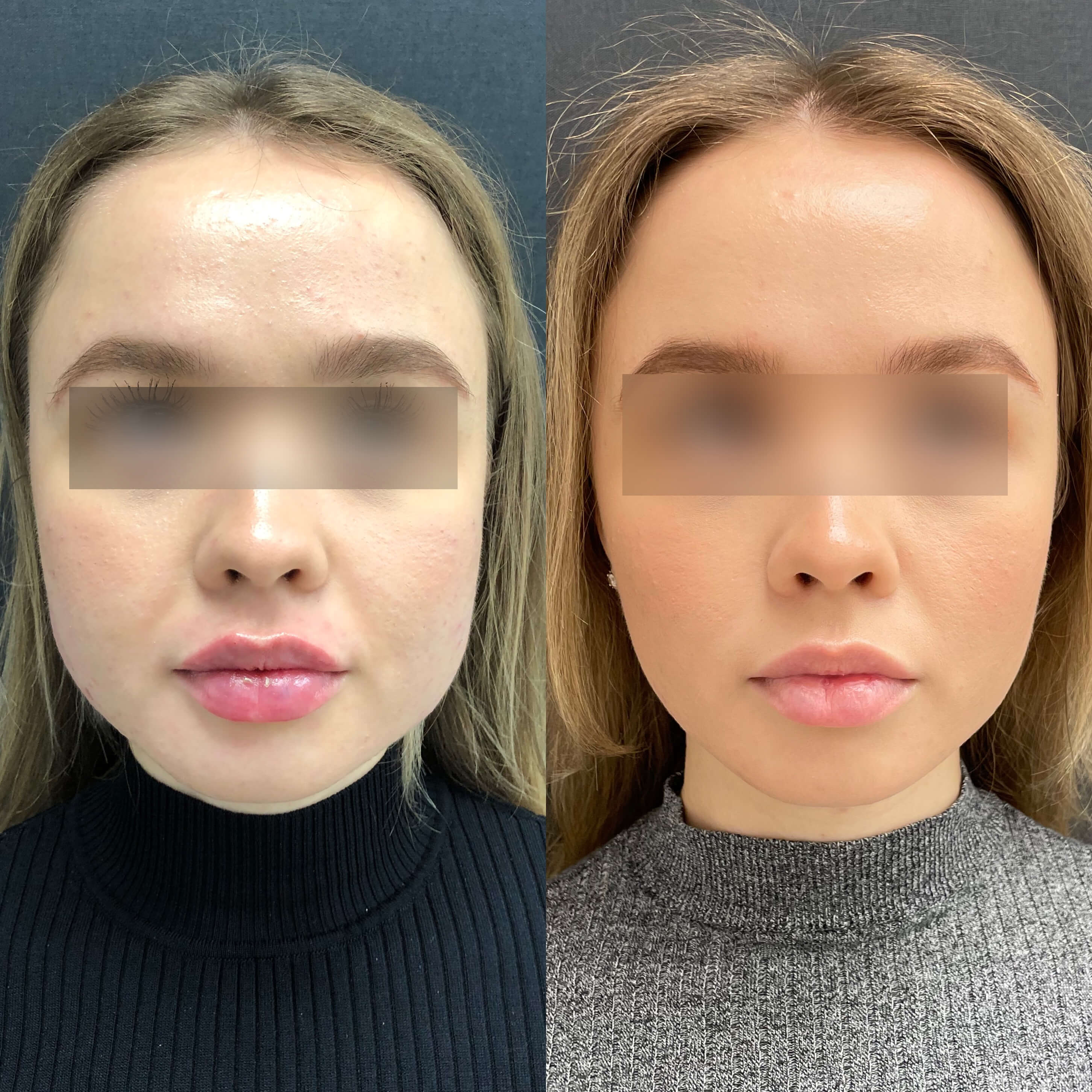 Обратившимся лицом. Процедура худое лицо. Биомоделирование лица худое лицо. Косметолог худое лицо. Процедура худое лицо до и после.