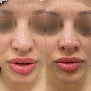 Коррекция формы носа